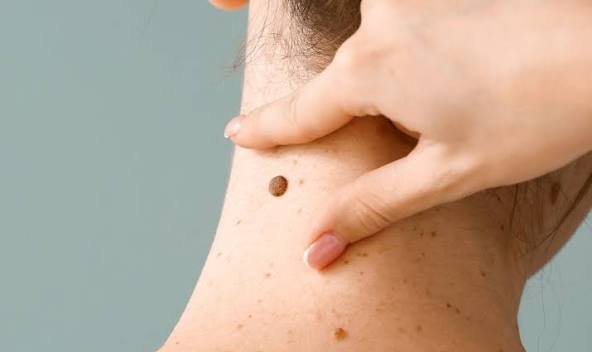 Instituto Dermatológico advierte aumento silencioso del cáncer de piel en el país